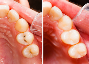 Think You May Have A Cavity? Dental Check-Up in Las Vegas